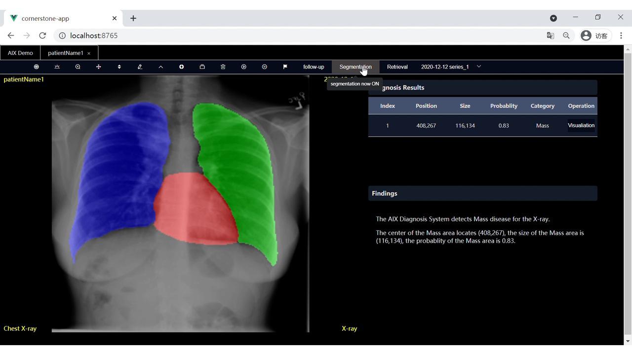 「AIX」人工智能胸部X光筛查