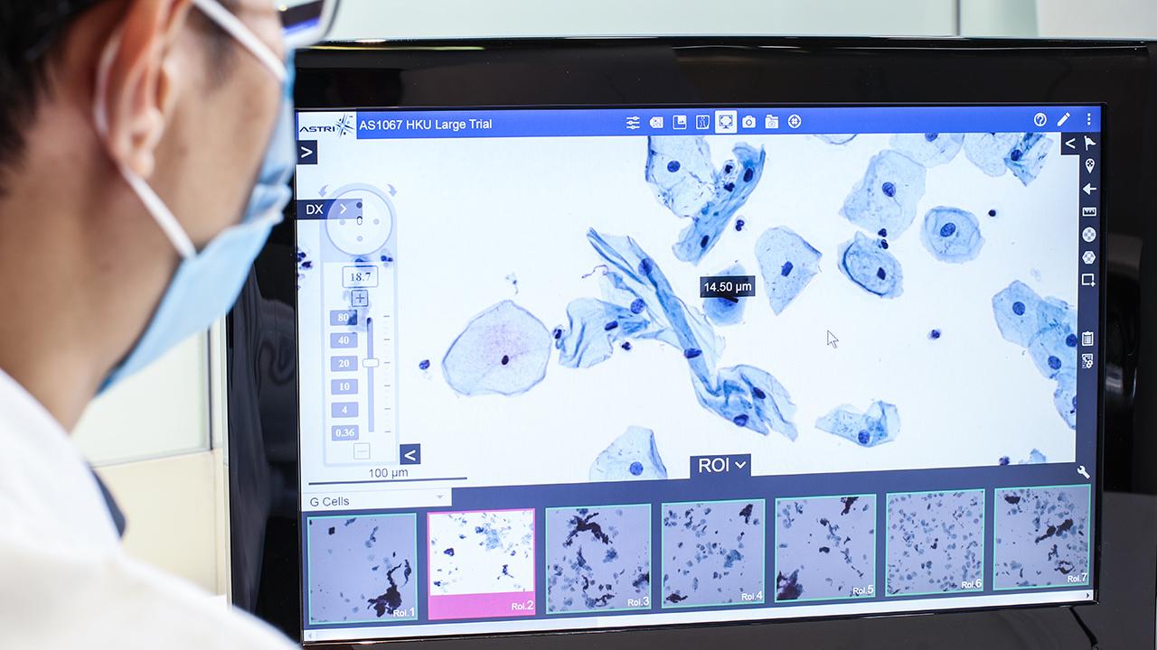 人工智能（AI）輔助醫學影像分析用於早期癌症篩查