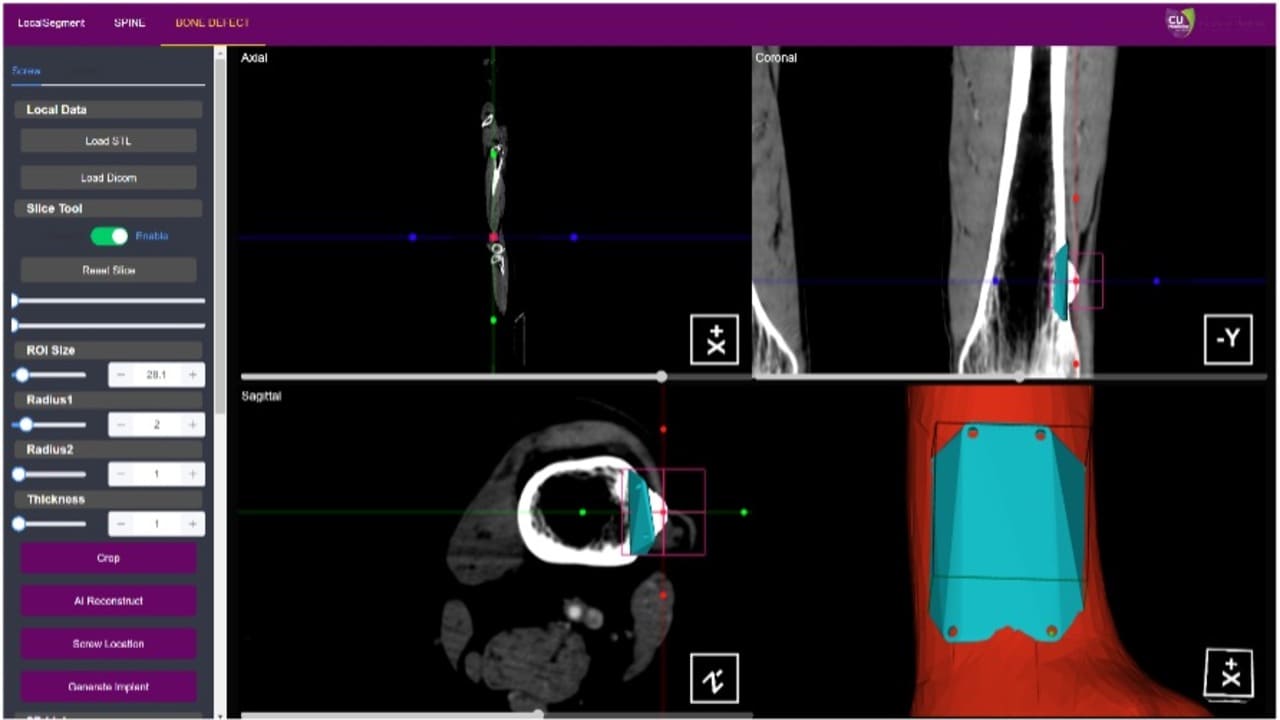 對骨缺損的自動化病人特定義肢設計系統